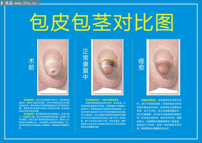包皮包茎对比图 分析治疗图